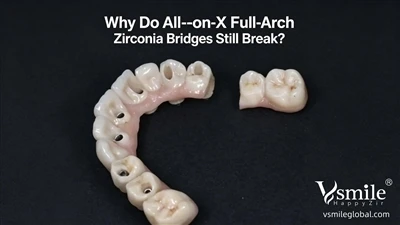 Perché i ponti All-on-X Full-Arch si rompono ancora? Una guida pratica per cl...